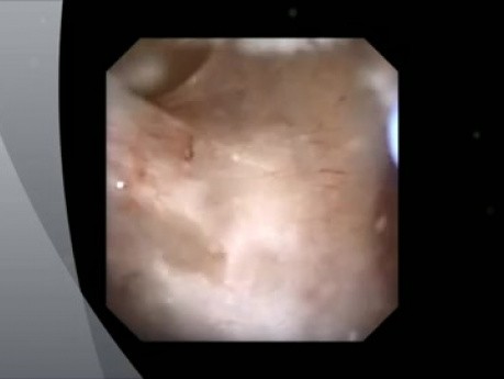 RIRS - Post Recurrent Ureteral Stricture Dilatation, Exploration of Hydroureteronephrosis 