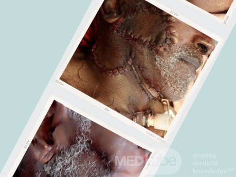 Male patient with a long-standing volume increase in the right parotid region