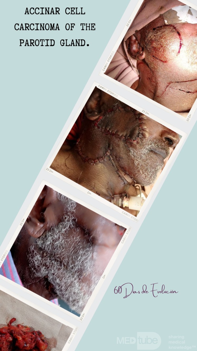 Male patient with a long-standing volume increase in the right parotid region