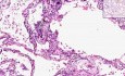 Lung, Kidney - Metastatic Calcification