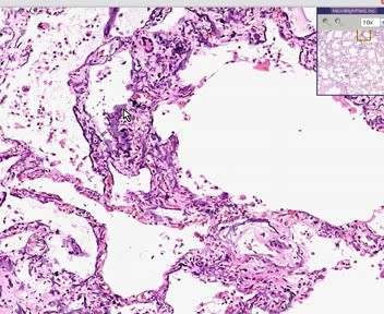 Lung, Kidney - Metastatic Calcification