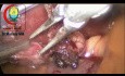 Extraction of Cystic Duct Stone May Be Like Difficult Labour