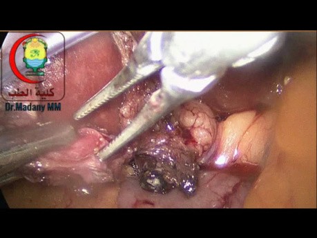 Extraction of Cystic Duct Stone May Be Like Difficult Labour