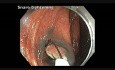 Endoscopic Mucosal Resection Of A Polyp: Catheter Flushing Before Injection