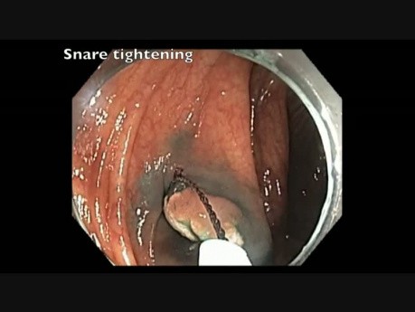 Endoscopic Mucosal Resection Of A Polyp: Catheter Flushing Before Injection