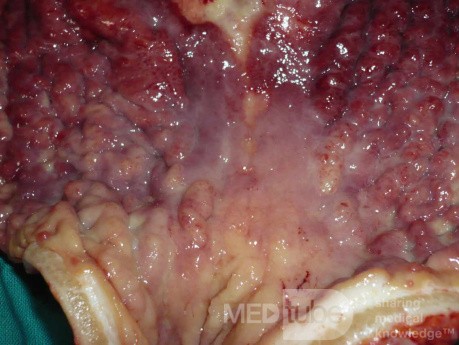 Endoscopy of Scirrhous Gastric Carcinoma involving the entire Fundus, Body and the Antrum (38 of 47)