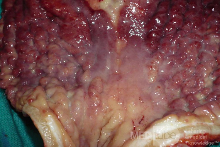 Endoscopy of Scirrhous Gastric Carcinoma involving the entire Fundus, Body and the Antrum (38 of 47)