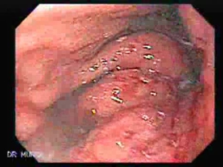 Gastric Lymphoma - Endoscopic Assessment of the Cardias and Fundus
