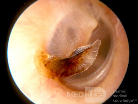 Separating Crust from Tympanic Membrane