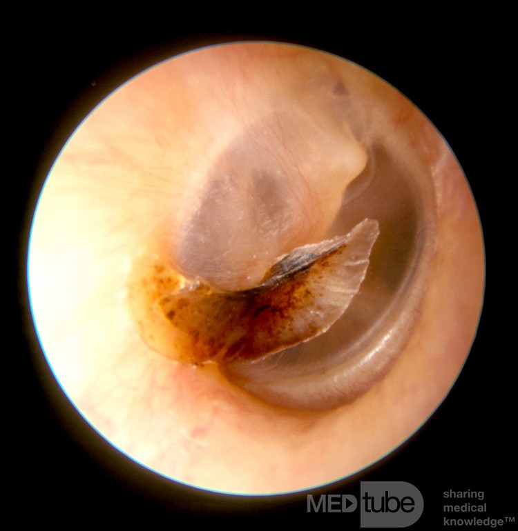 Separating Crust from Tympanic Membrane