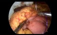 Laparoskopische gastrointestinale Anastomose mit Enterostomie