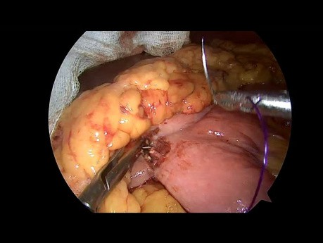 Laparoscopic 3 Trocars Gastro-Jejunal Anastomosis with Braun Enteroenterostomy