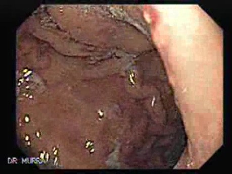 Multiple Gastric Angiodysplasia (2 of 17)