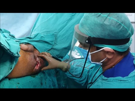 Risk of Fecal Incontinence Loss of Sphincter Control During Fistula in Ano Surgery Temporary or Permanent Colostomy