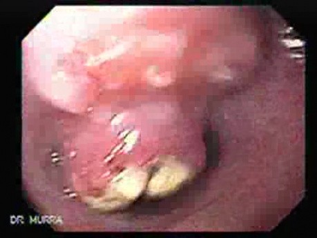 Small Cell Carcinoma of the Lung that Invades the Upper and the Middle Third of the Esophagus - Closer Look at the Lesion