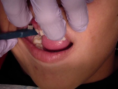Orthodontic Band Seating 101