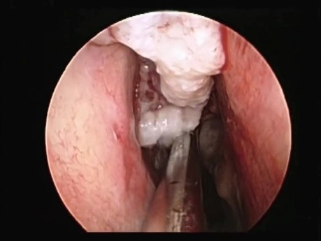 Endoscopic Shaving of Nasal Polyps