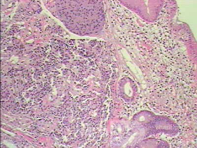 Gastric Carcinoid tumor (7 of 8)