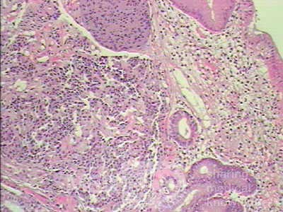 Gastric Carcinoid tumor (7 of 8)