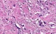 Adenocarcinoma - Histopathology  - Esophagus