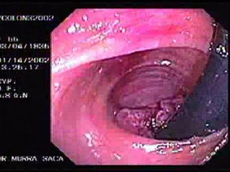 Rectal Endoscopy - Adenocarcinoma (2 of 3)