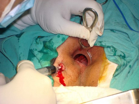 Fistula in Ano (6 of 7)