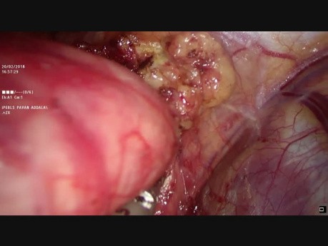 Laparoscopic Nissens Fundoplication