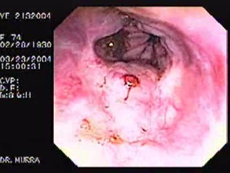Variceal Hemorrhage - Site of Bleeding