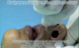 Bloodless Rhinoplasty