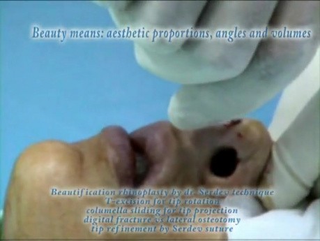 Bloodless Rhinoplasty