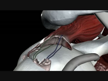 Rotator Cuff Surgery
