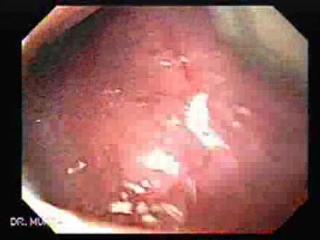 Squamous cell carcinoma of the tongue -exophytic mass (2 of 3)