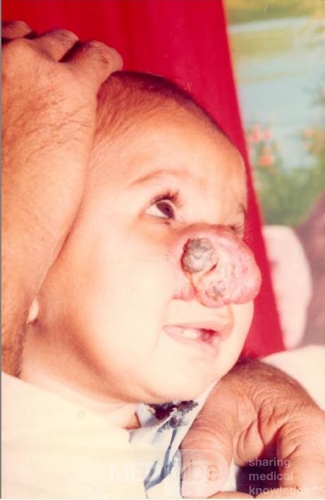 Haemangioma Of The Nose