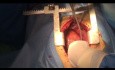 Simultaneous Heart and Kidney Transplant 