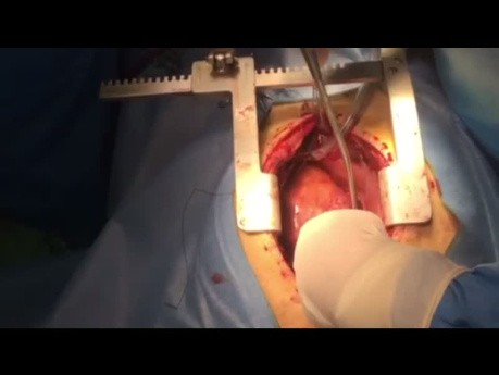 Simultaneous Heart and Kidney Transplant 
