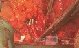 Atrial Resection for T4 Non-small Cell Lung Cancer with Left Atrium Involvement
