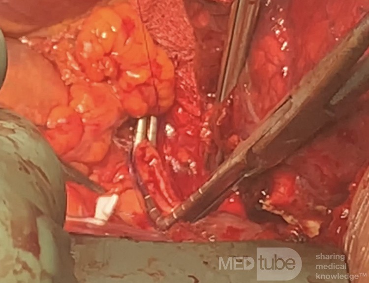 Atrial Resection for T4 Non-small Cell Lung Cancer with Left Atrium Involvement