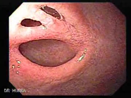 Duodenal Perforation
