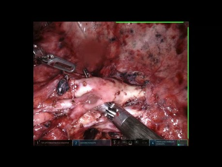 Right Basilectomy with Adhesions