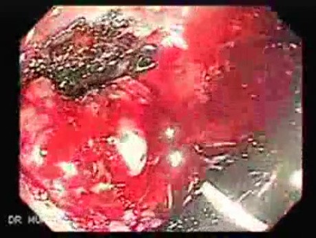 Endoscopic Resection of Giant Tubulo-Villous of the rectum (16 of 35)