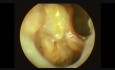 Endoscopic Examination of a Mastoid Cavity After Congenital Cholesteatoma Surgery