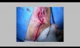 Vulvar Tumor Granular Cells Exeresis and Island Transplant