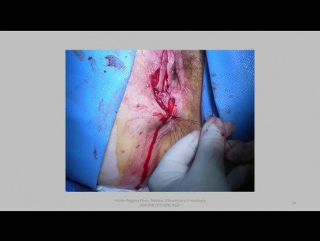 Vulvar Tumor Granular Cells Exeresis and Island Transplant