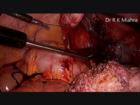 Laparoscopic Myomectomy
