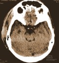 Acute Spontaneous Subdural Hemorrhage in the Subdural Space