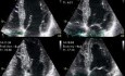 Rapid Atrial Fibrillation Dobutamine Induced