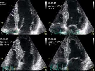 Rapid Atrial Fibrillation Dobutamine Induced