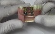 Implant Crown & Bridge - Model Demonstration