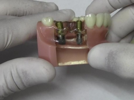 Implant Crown & Bridge - Model Demonstration