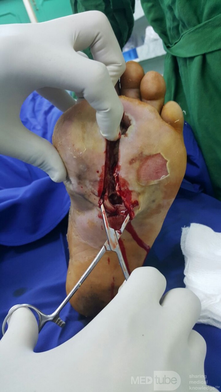 Diabetic Foot Ulcer with Infection 